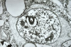 M,28y. | Leishmania - skin M,28y. | Leishmania - skin